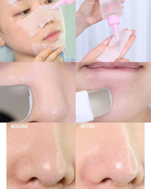 Dung Dịch Ủ Mụn ILSO Melting Sebum Softener 150g
