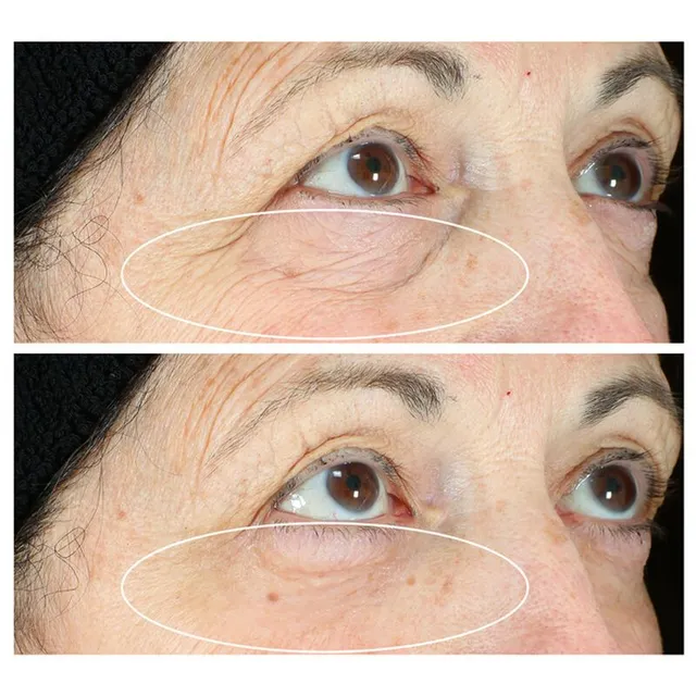 Kem Xo&aacute; Tan Bọng Mắt Hyperlift Eye&trade;