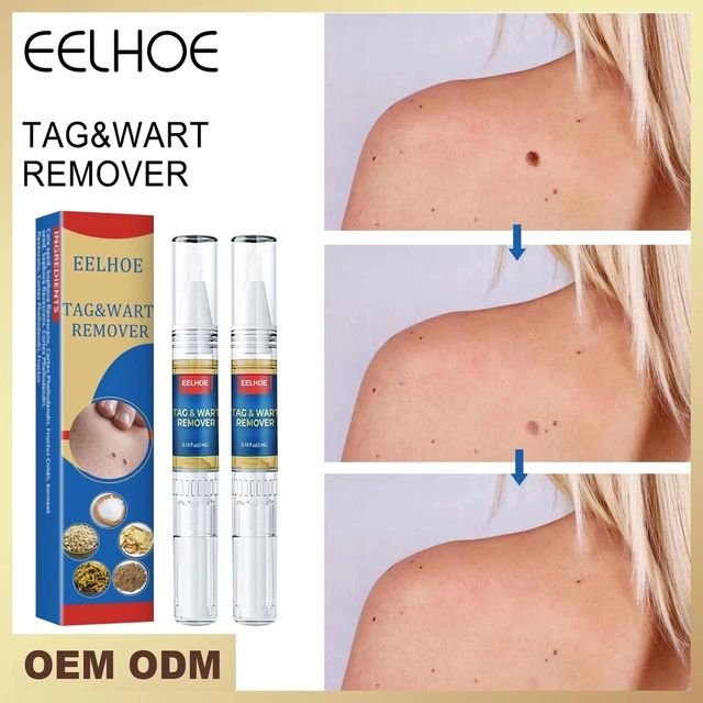 Tẩy nốt ruồi