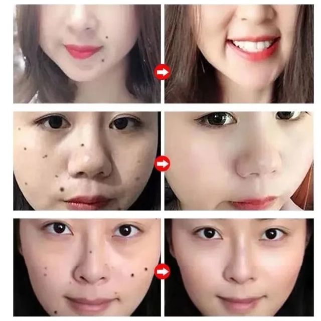 Tẩy nốt ruồi hiệu quả