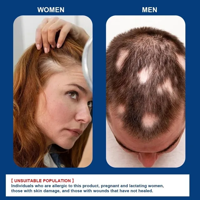 Kem Mọc T&oacute;c Alopecia Hair Growth Cream