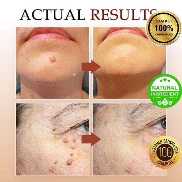 B&uacute;t Tẩy Nốt Ruồi Tr&ecirc;n Da