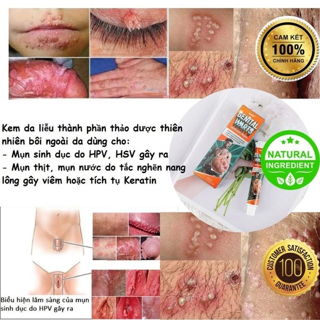 Kem B&ocirc;i Nấm Ngứa V&ugrave;ng K&iacute;n