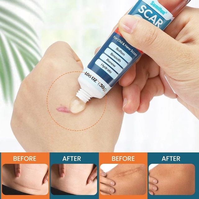 Gel B&ocirc;i Sẹo