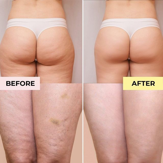 Kem Somatoline Chống Cellulite
