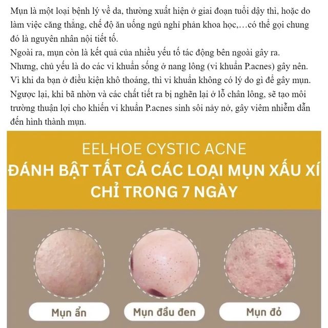 Kem giải quyết mụn