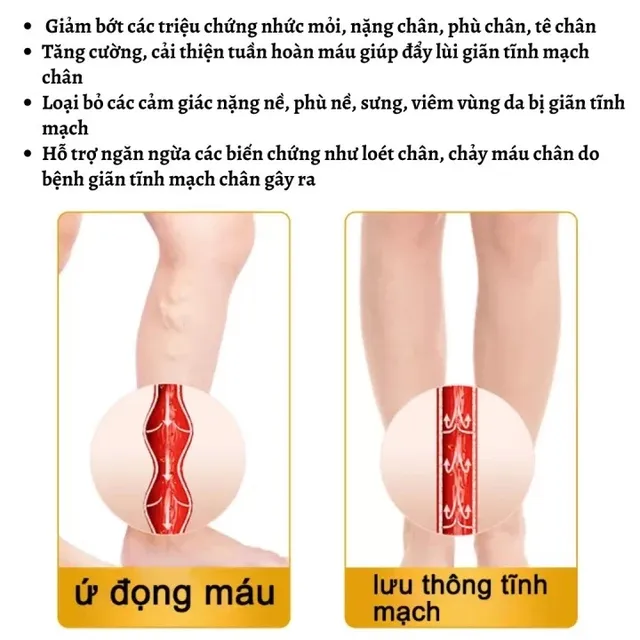 Kem B&ocirc;i Gi&atilde;n Tĩnh Mạch