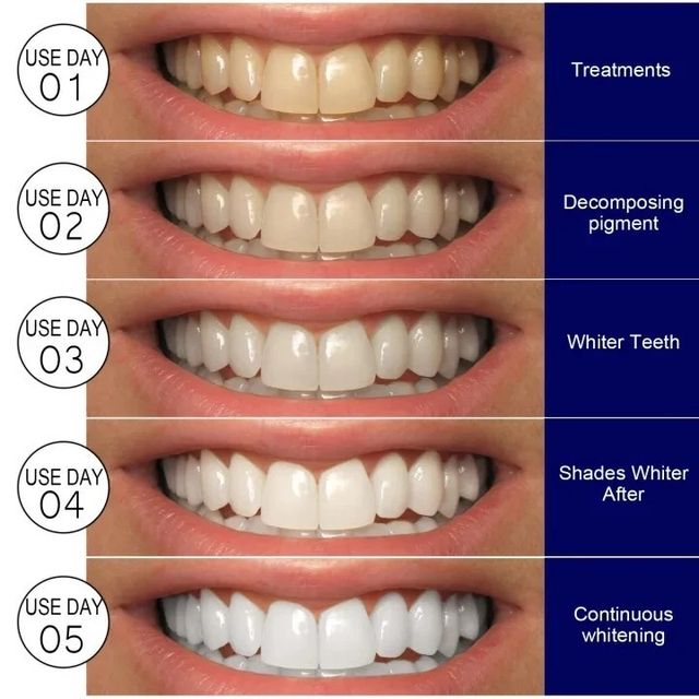 Miếng d&aacute;n trắng răng hiệu quả nhanh