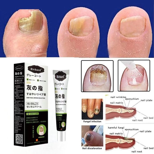 Kem b&ocirc;i nấm m&oacute;ng tay Nhật Bản 20G