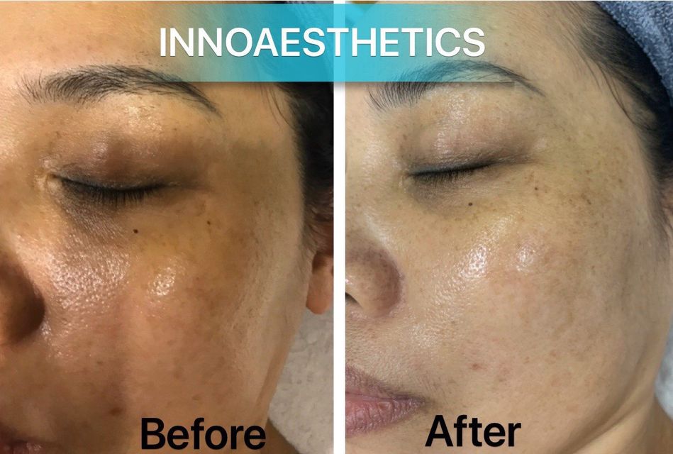 INNOAESTHETICS LIGHTENING A CREAM