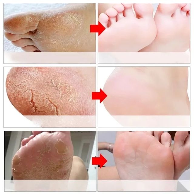 Kem Nứt G&oacute;t Ch&acirc;n Th&aacute;i Lan