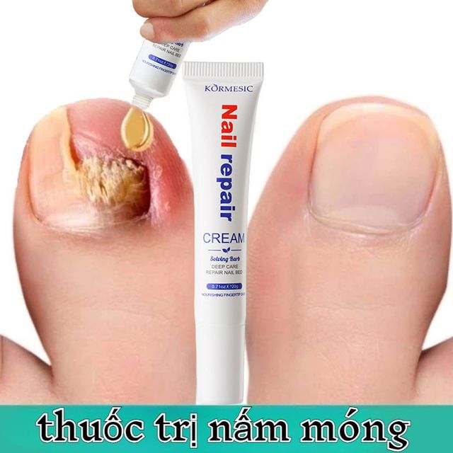Serum Nấm M&oacute;ng Tay Ch&acirc;n ngừng hẳn Sạch Nấm