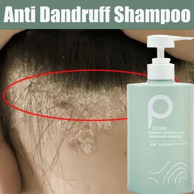 Dầu gội b&ocirc;i da nấm da đầu