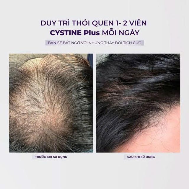 CYSTINE Plus hỗ trợ t&oacute;c v&agrave; da khỏe mạnh