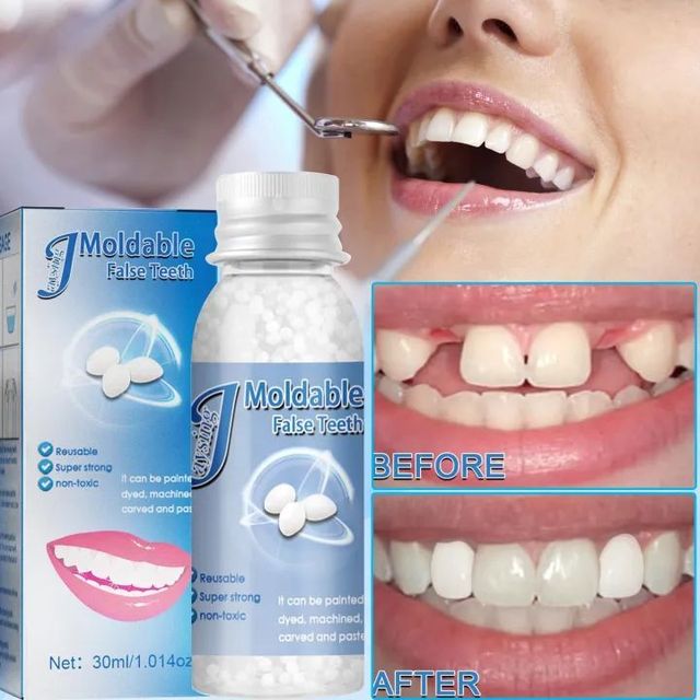 Sản phẩm Keo d&aacute;n răng Nhựa Nha Khoa Tạm Thời