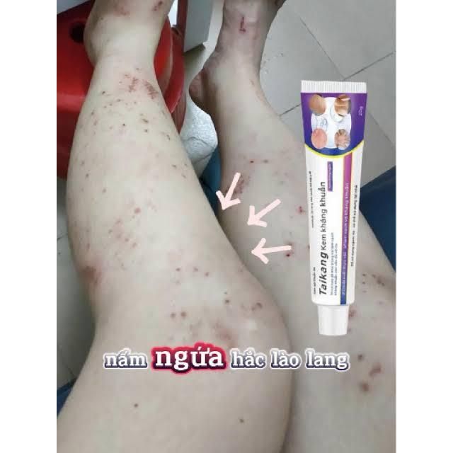 WJG Kem Giảm ngứa do muỗi đốt 3
