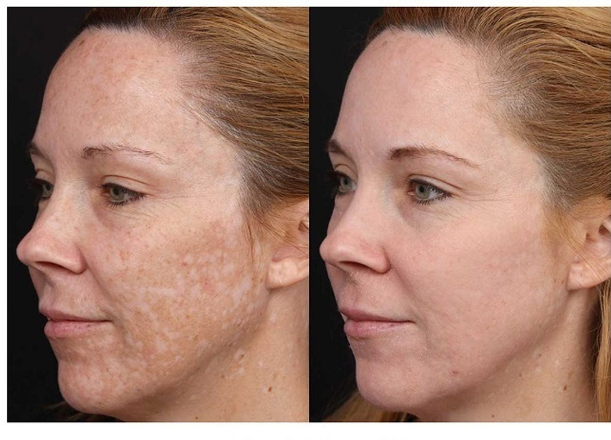 H&igrave;nh ảnh kem giảm n&aacute;m Mesoestetic Cosmelan 2