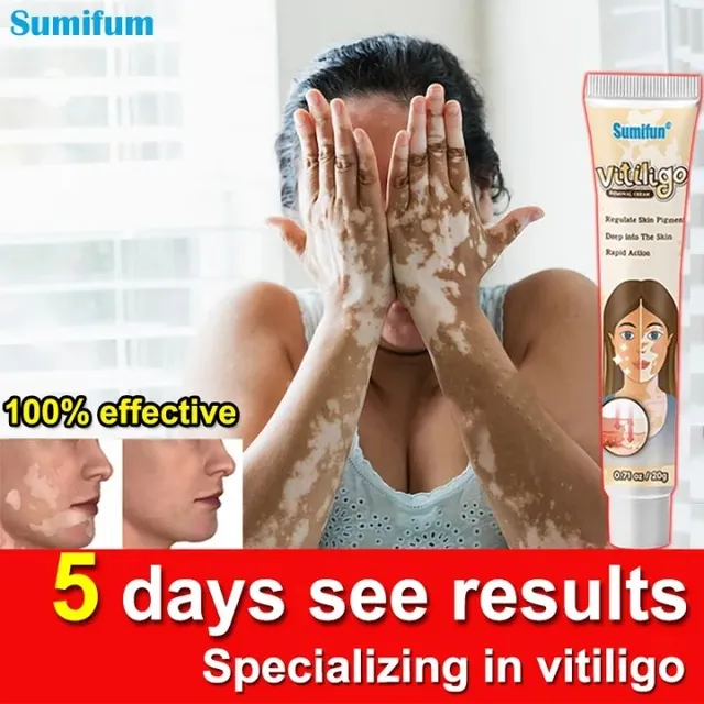 Kem Đốm Trắng Vitiligo Removal Cream