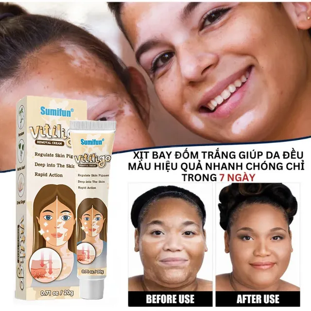 Hướng dẫn sử dụng Kem Đốm Trắng Vitiligo