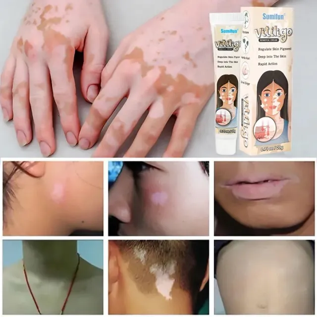 Kem Đốm Trắng Vitiligo