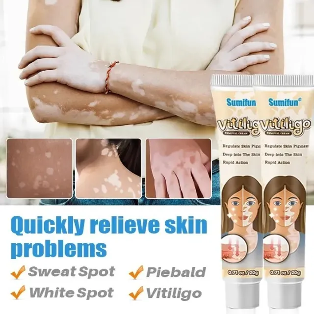 Kem l&agrave;m sạch đốm trắng Vitiligo