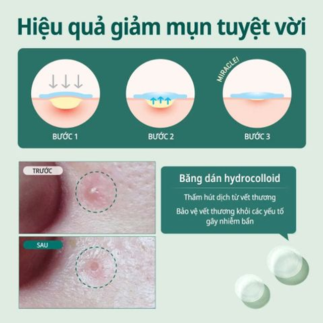 Miếng D&aacute;n Mụn Some By Mi Clear Spot Patch 5