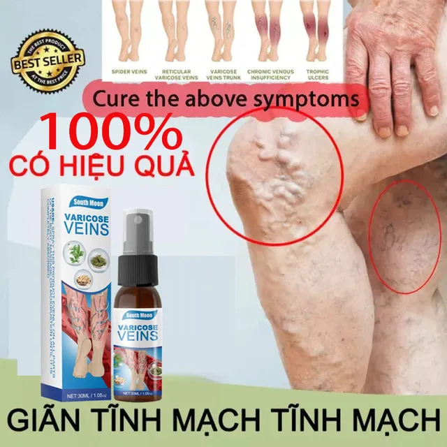 Sản phẩm xịt phục hồi tĩnh mạch