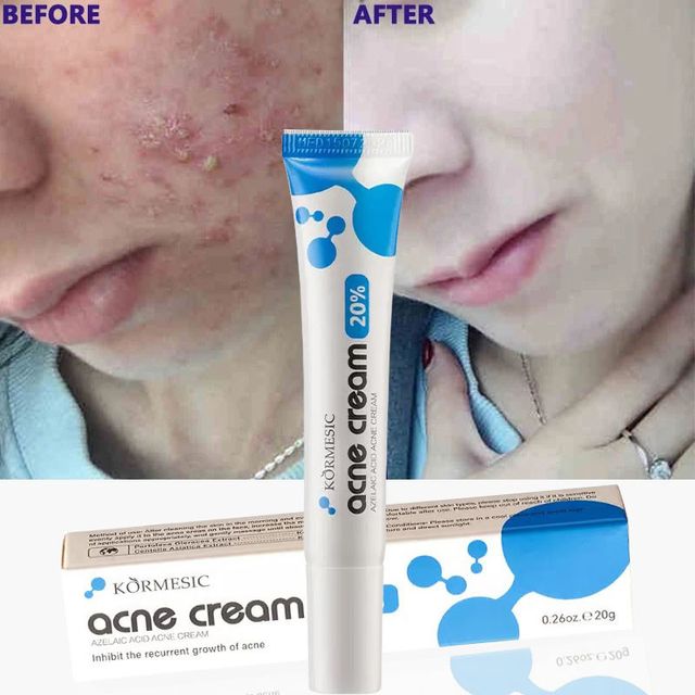 AZELAIC ACID Kem chấm mụn