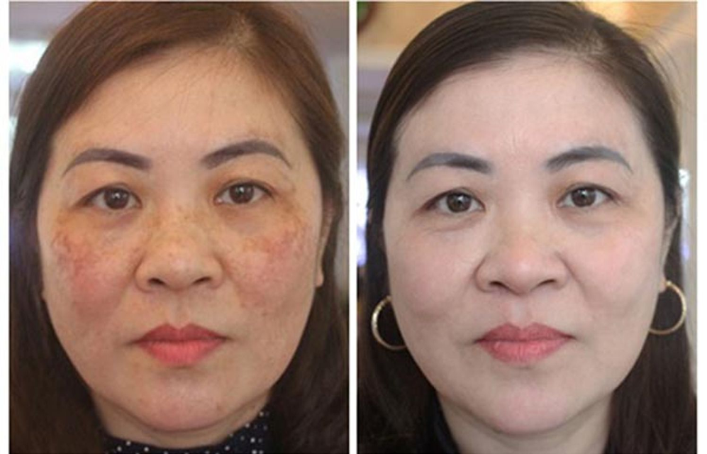 Kem giải quyết N&aacute;m  Obagi Nu-Derm Clear số 3