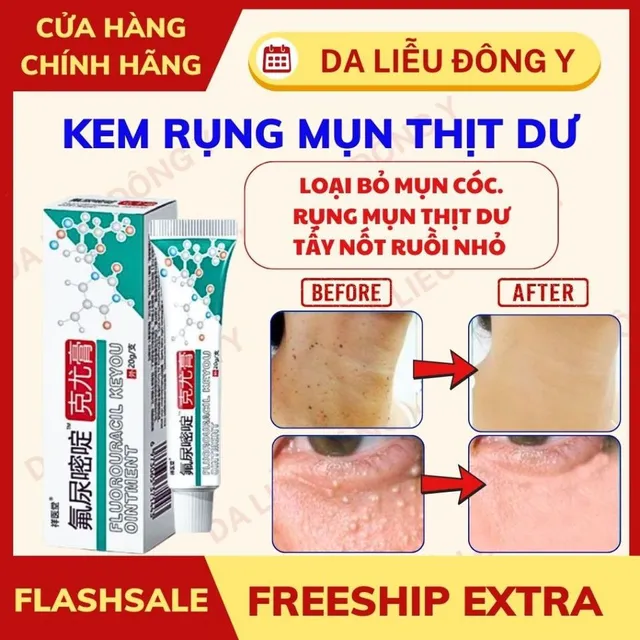 Kem Rụng Mụn Thịt Dư Keyou
