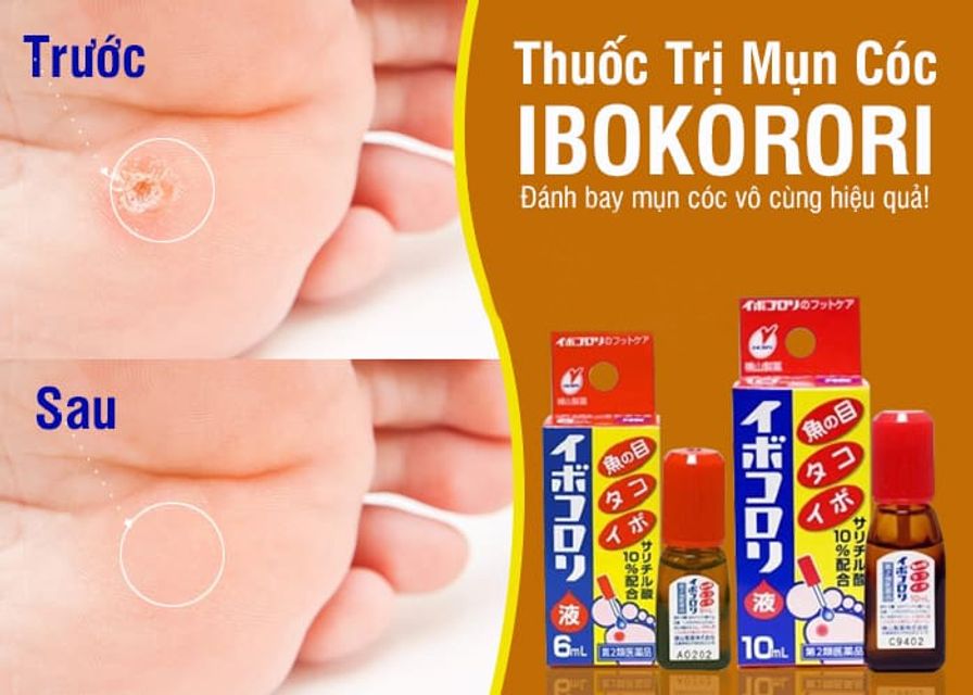 Dung dịch Ibokorori loại bỏ mụn c&oacute;c