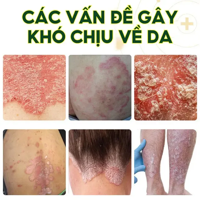 Kem b&ocirc;i da liễu Nhật Bản