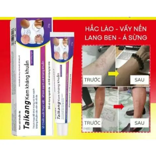 B&aacute;n chạy WJG kem Giảm ngứa do muỗi đốt