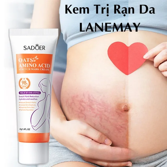 Kem x&oacute;a sẹo mang thai