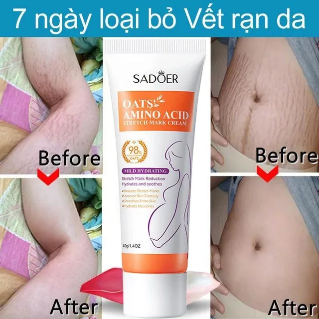 Kem x&oacute;a rạn da SADOER