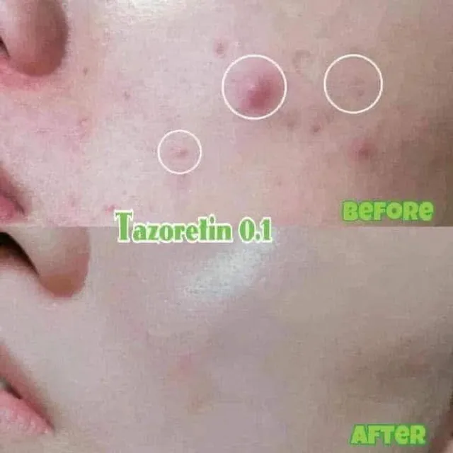 Gel Đẩy Mụn Tazoretin Xanh