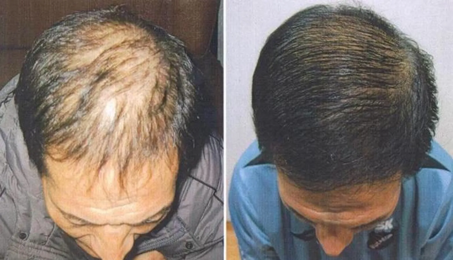 Восстановление выпадения волос. Лысина у мужчин. Поредение волос на макушке у мужчин. Редеющие волосы у мужчин.