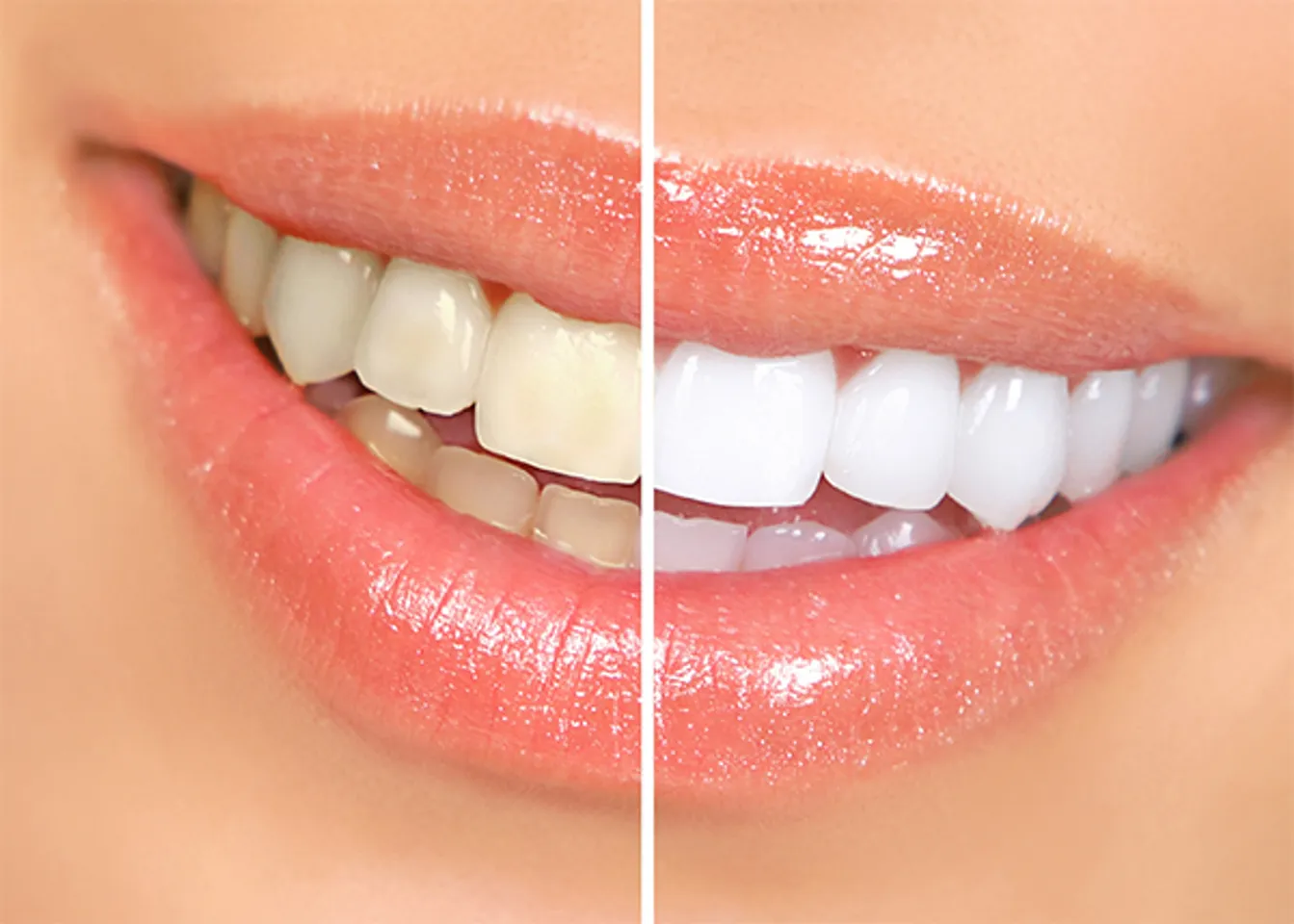 Độ trắng sáng của răng trước và sau khi sử dụng