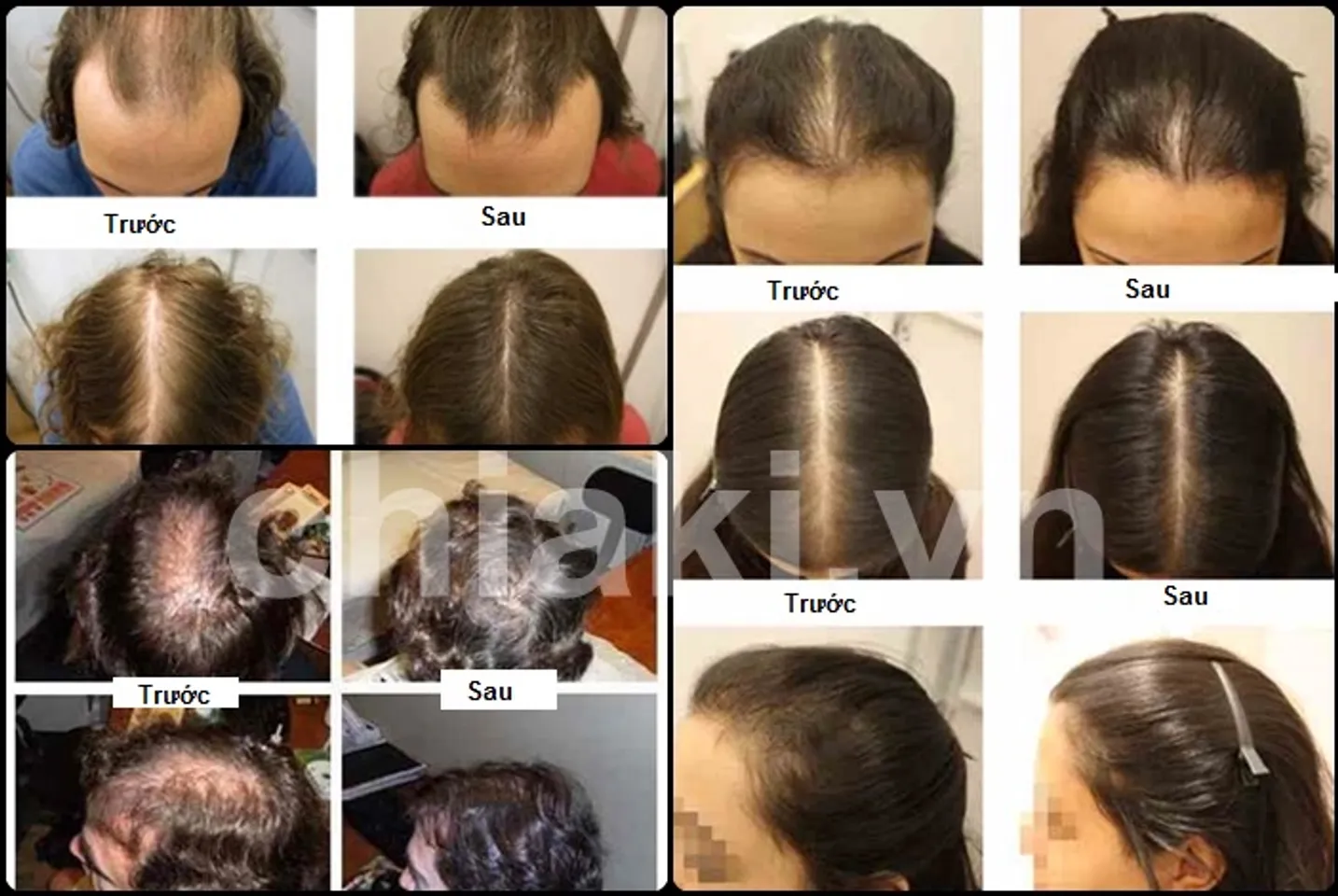  Hiệu quả sử dụng bổ sung Keratin phục hồi tóc hư tổn nặng