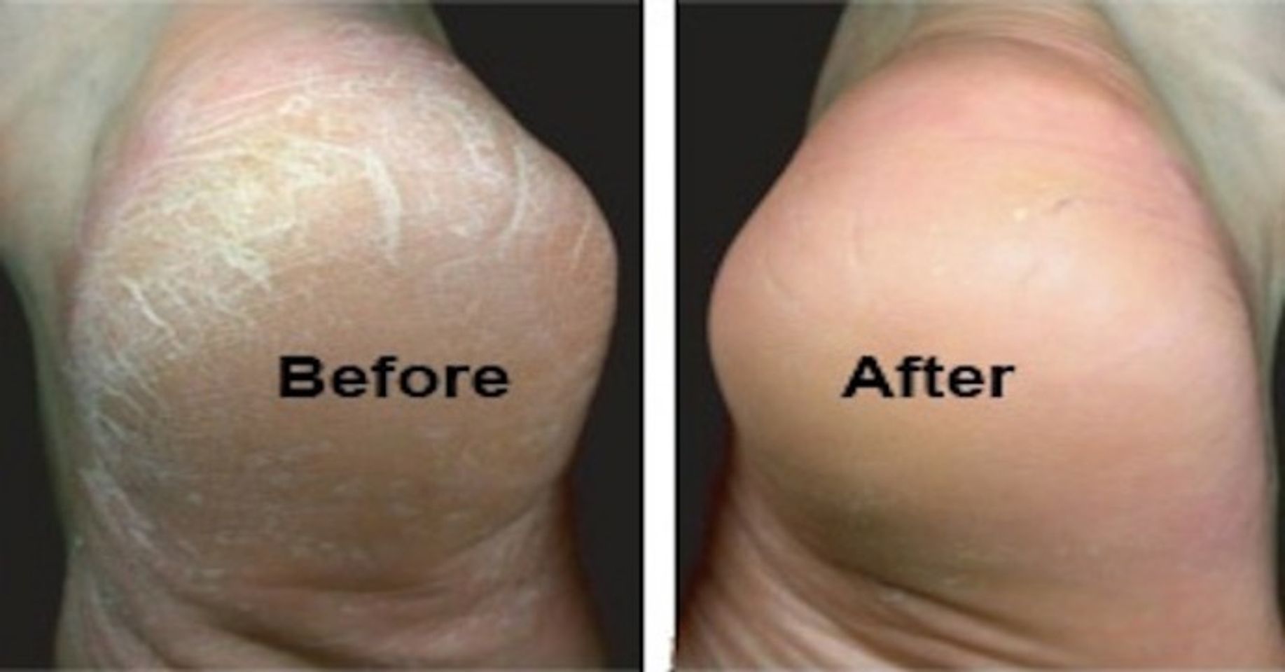 Trước và sau khi sử dụng kem trị nứt gót chân Muhi