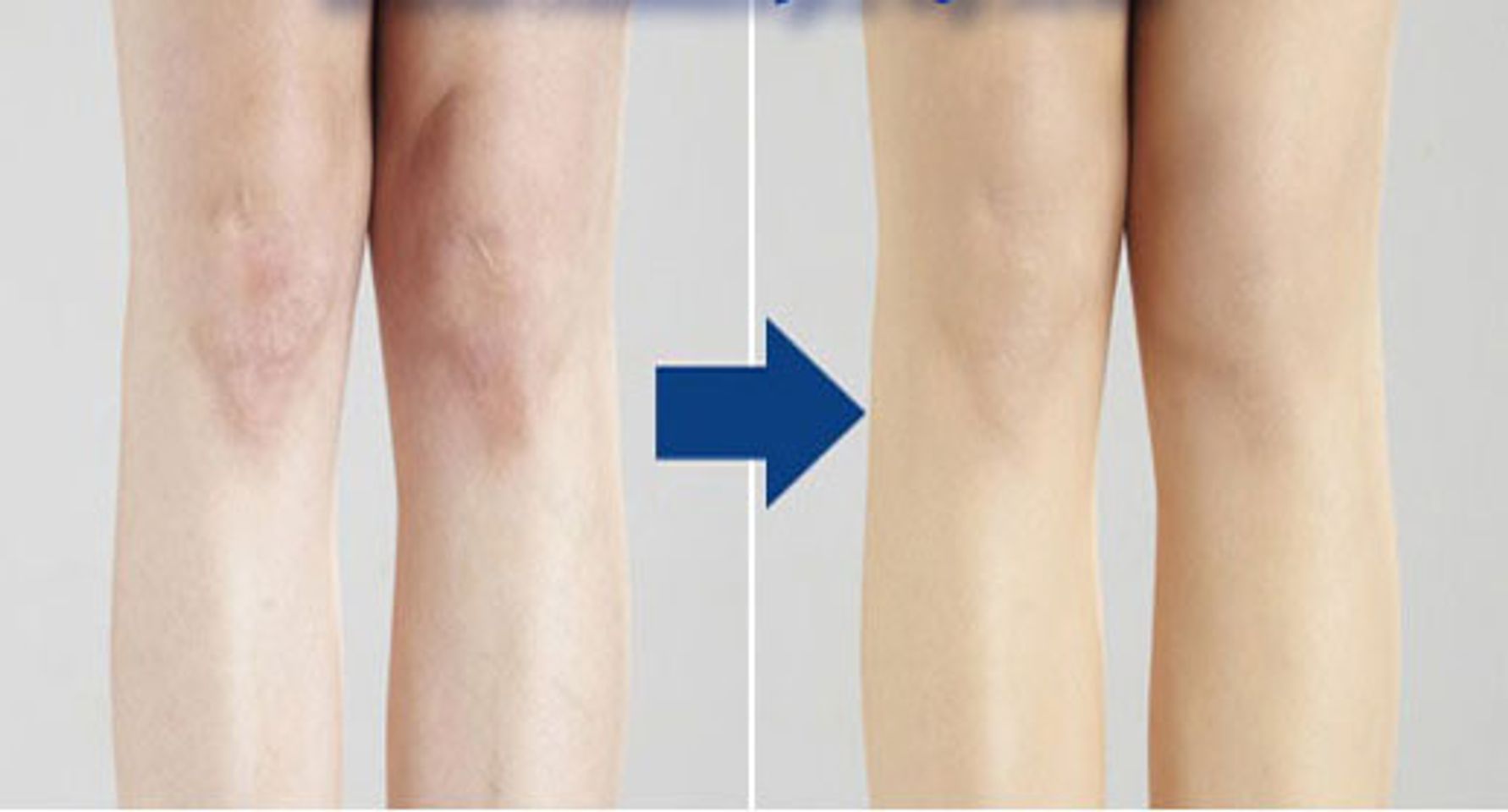 Tất phun Nhật Bản giúp che mờ tới 80% - 90% các khuyết đểm trên đôi chân bạn