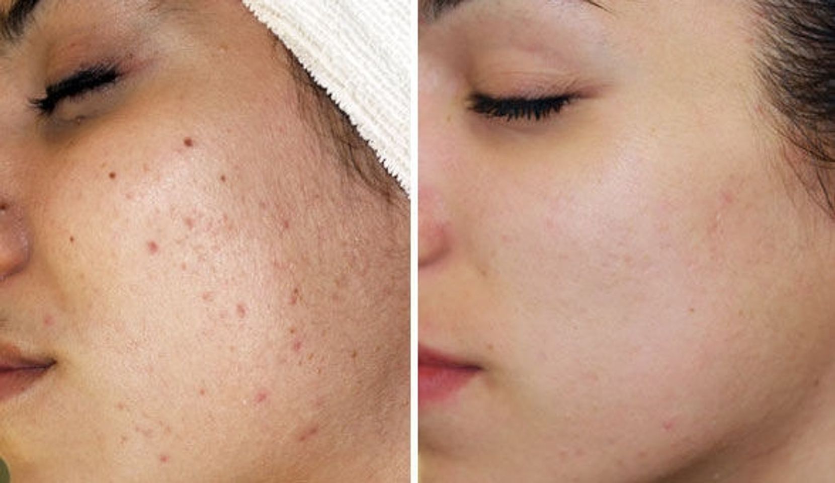 Hanajirushi acne gel nhanh chóng loại bỏ mụn