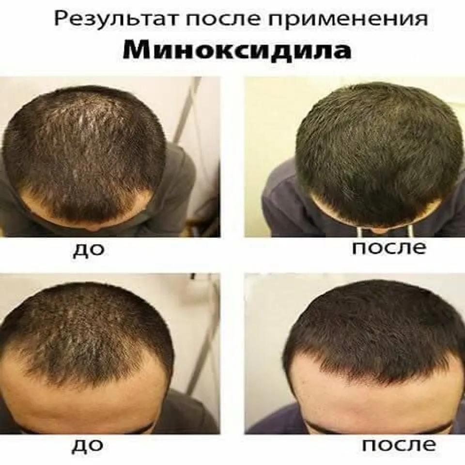 Xịt kích mọc tóc, hỗ trợ trị hói Eksiderm của Nga có tốt không