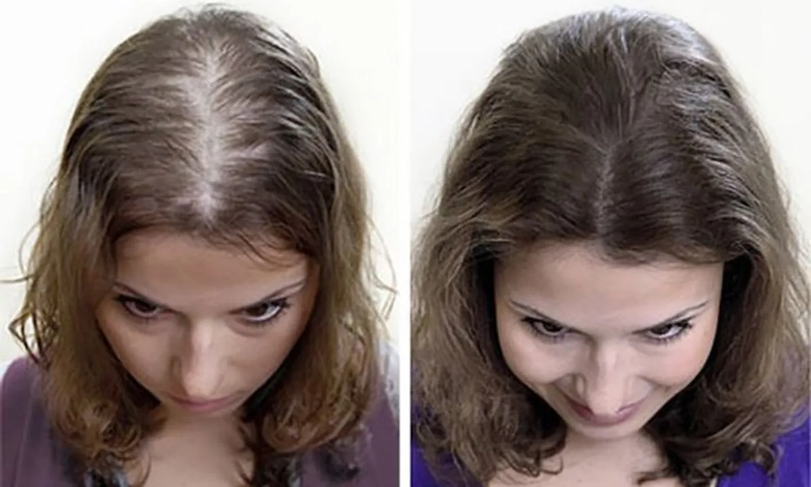 Công dụng Xịt kích mọc tóc, hỗ trợ trị hói Eksiderm của Nga