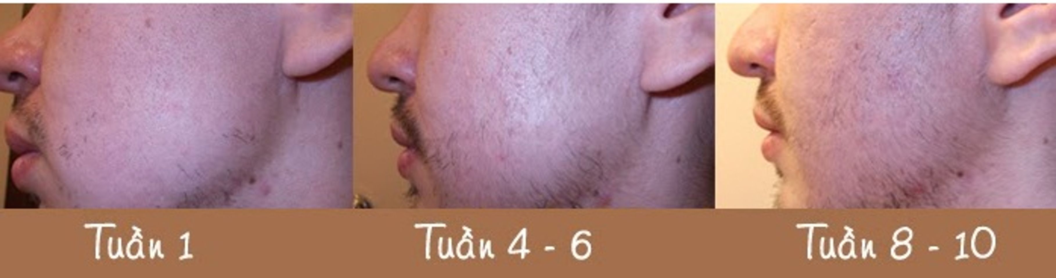 Kích thích mọc râu Nioxin Intensive Therapy Hair Booster mang tính chất trị liệu chuyên sâu lỗ chân lông