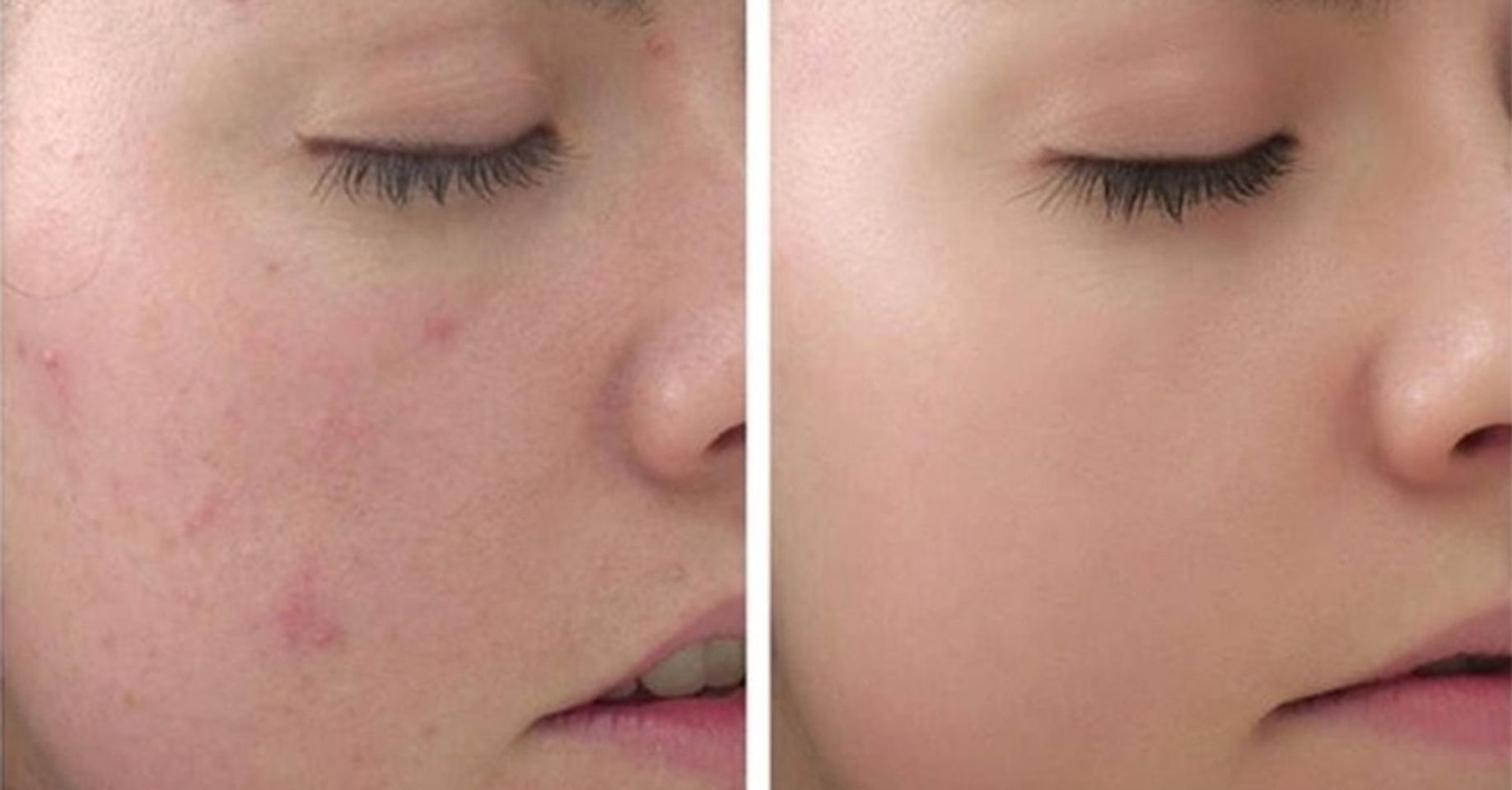 Gel trị mụn Clean & Clear Advantage Acne Spot Treatment 2