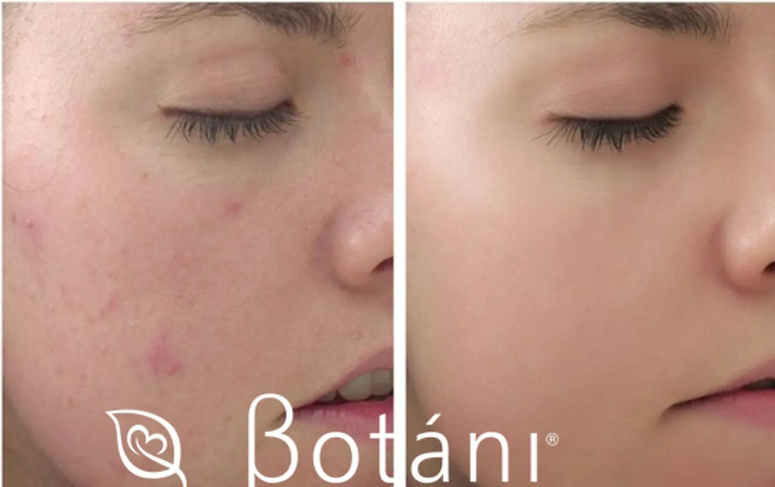 Kem trị mụn Botani Rescue Ance Cream thành phần hữu cơ 2