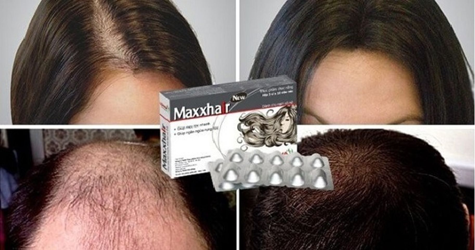 [GIẢI ĐÁP] Viên uống Maxxhair hỗ trợ mọc tóc, giảm rụng tóc có tốt không?