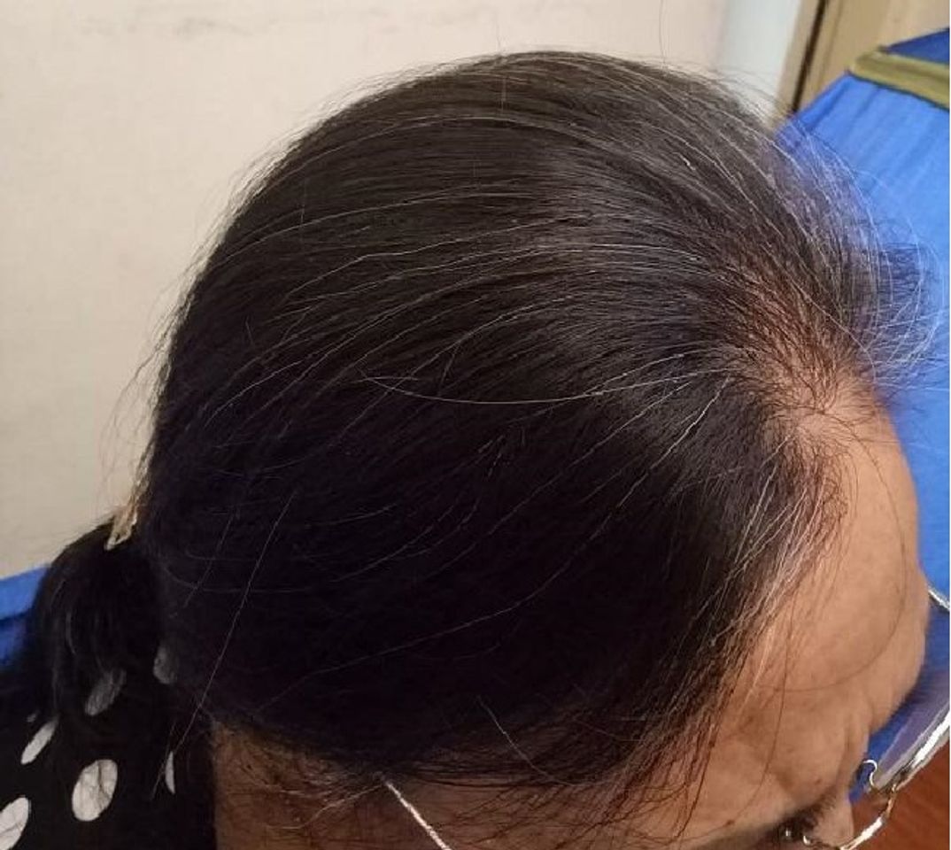 [GIẢI ĐÁP] Viên uống Maxxhair hỗ trợ mọc tóc, giảm rụng tóc có tốt không?