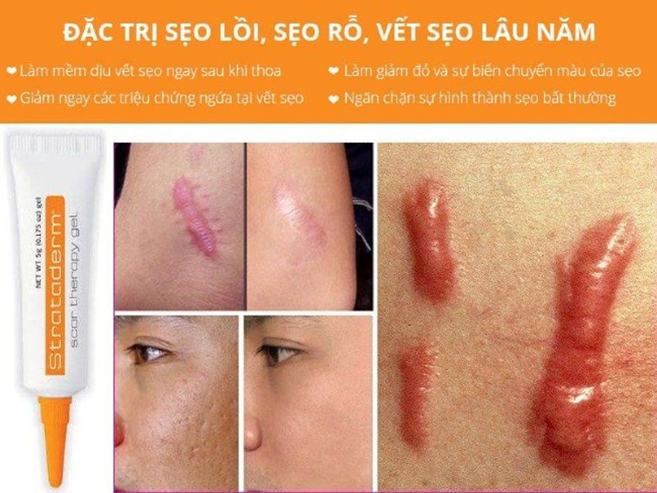 [ĐÁNH GIÁ] Strataderm có trị được sẹo lồi không? 
